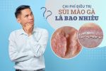 Những điều quyết định chi phí điều trị sùi mào gà hiện nay