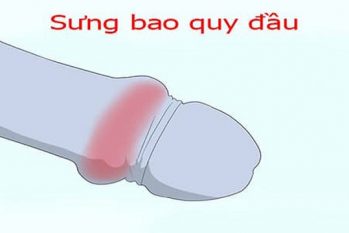Sưng bao quy đầu sau khi quan hệ – Dấu hiệu của nhiều bệnh lý nam khoa