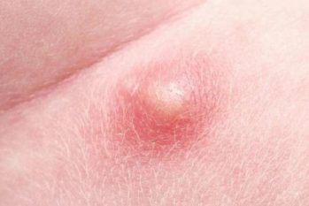 Đầu dương vật nổi mụn đỏ không ngứa : Nguyên nhân + Cách chữa