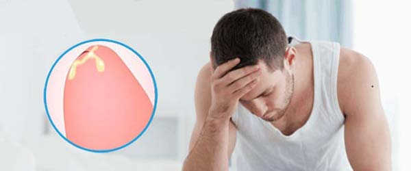 Dương vật chảy mủ 90% bạn đã mắc bệnh lậu