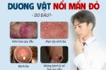 Đầu dương vật nổi mẩn đỏ ngứa – Cảnh giác 8 bệnh nguy hiểm