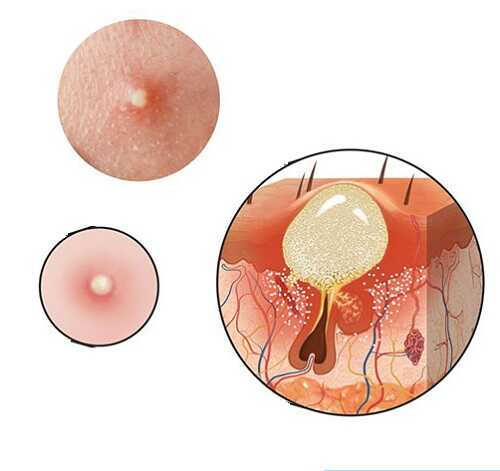 Nổi mụn bao quy đầu – Cảnh báo bệnh xã hội nguy hiểm, đừng chủ quan!