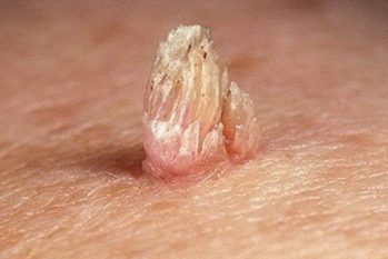 Mụn cóc sinh dục: Dấu hiệu nhận biết và Cách khắc phục hiệu quả