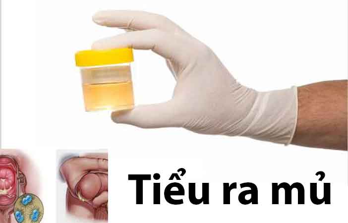 Tiểu buốt có mủ – Dấu hiệu chớ được xem thường