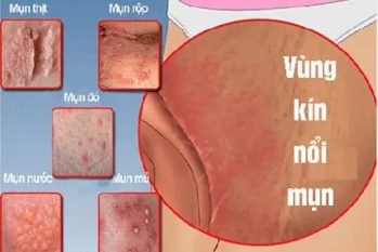Nổi mụn vùng kín – Dấu hiệu cảnh báo bệnh nguy hiểm