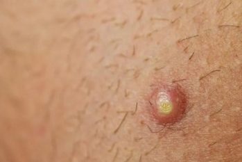 Các loại mụn dương vật: Nguyên nhân và phương pháp hiệu quả