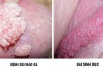 Bác sĩ Lê Minh Lộc hướng dẫn phân biệt sùi mào gà và gai sinh dục