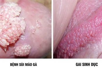Bác sĩ Lê Minh Lộc hướng dẫn phân biệt sùi mào gà và gai sinh dục