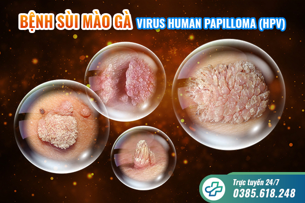 Mách bạn 5 dấu hiệu sùi mào gà điển hình, dễ nhận biết nhất