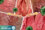 Điều cần biết về bệnh sùi mào gà ở âm đạo nữ giới