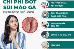 Chi phí đốt sùi mào gà bao nhiêu tiền – Bảng giá chi tiết tại Phòng Khám Đa Khoa HCM