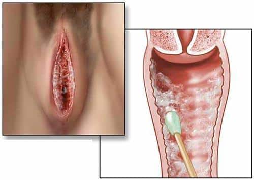 [CẢNH BÁO] Những hình ảnh bệnh lậu dễ gặp nhất ở sinh dục, miệng, hậu môn