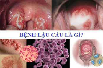 Vi Khuẩn Nhỏ – Hậu Quả Lớn: Vén Màn Tác Nhân Gây Bệnh Lậu Đáng Sợ Nhất