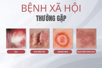 Dấu hiệu bệnh xã hội thường gặp – Nhận biết đúng để điều trị kịp thời