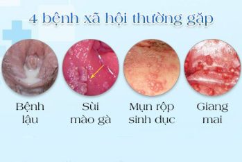 Tổng hợp một số bệnh hoa liễu nguy hiểm thường gặp ở nam và nữ giới