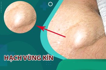 Hạch vùng kín: Dấu hiệu bất thường nam nữ không nên chủ quan