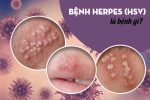 Herpes sinh dục: Căn bệnh tình dục gây nhiều biến chứng nguy hiểm