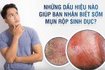 Cảnh báo mụn rộp sinh dục nam: Căn bệnh nam giới không nên chủ quan