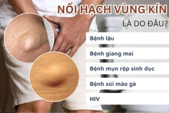 Nổi hạch ở vùng kín: Cảnh báo những bệnh lý nguy hiểm đang rình rập