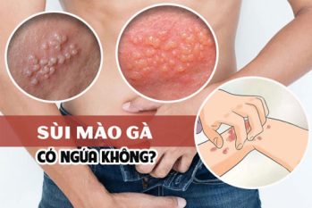 Sùi mào gà có ngứa không? Triệu chứng dễ bỏ qua khiến bệnh nặng hơn