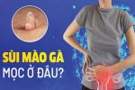 Sùi mào gà mọc ở đâu? Những vị trí thường gặp và dấu hiệu nhận biết