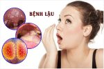 Bệnh lậu ở miệng: Dấu hiệu, Nguyên nhân & Cách khắc phục hiệu quả