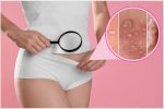 Hình ảnh mụn vùng kín ở nam và nữ giới