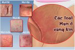 Mọc mụn ở vùng kín là bị gì? Khi nào cần đi thăm khám?