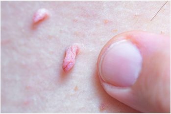 Nổi mụn cơ quan sinh dục bất thường không nên chủ quan!