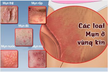 Mọc mụn ở vùng kín là bị gì? Khi nào cần đi thăm khám?